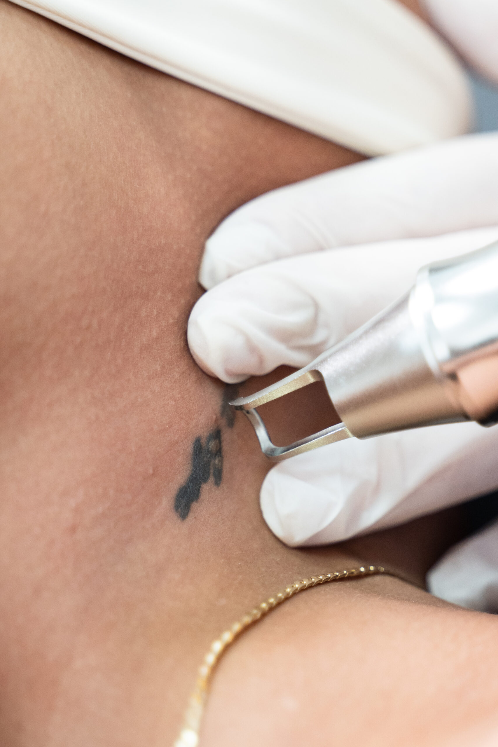 RemoçãoLaserTatuagem